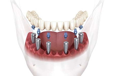 Illustration of implant denture supported by six implants