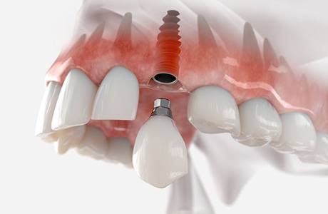 Illustration of traditional dental implant in upper jaw