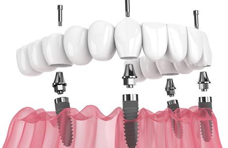 Illustration of All-on-X denture for lower arch