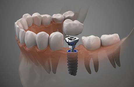 Illustration of traditional dental implant between natural teeth