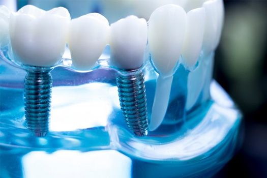 Close up of an implant bridge model