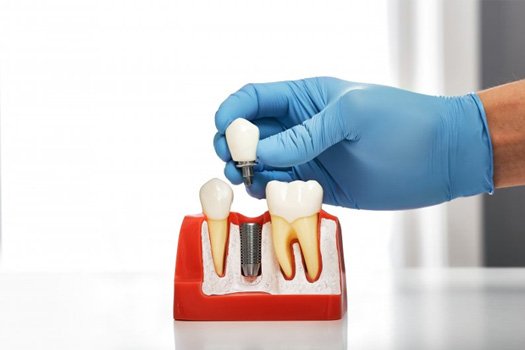 Close up of dentist lifting an implant crown off of a model implant post