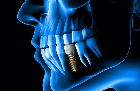 Illustrated x ray of a person with one dental implant