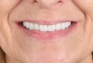 Close up of smile with white teeth