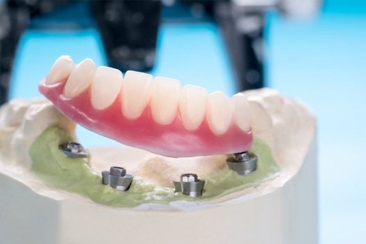 A denture resting on a model with four dental implants imbedded in the wax