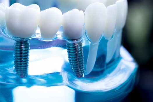 Transparent dental model that shows two dental implant posts