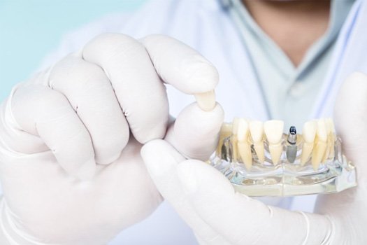 Dentist holding an implant crown and a dental model with a single implant post