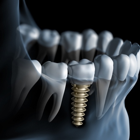 Illustrated x ray of a person with a dental implant replacing a missing tooth
