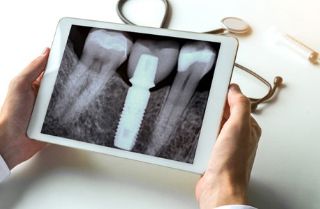 Held tablet showing an x ray of a jawbone with a  dental implant