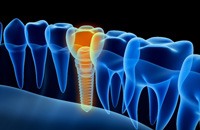 Digital illustration of an X ray view of a placed dental implant