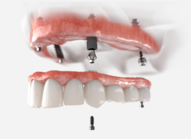 Model of an upper denture being attached to four dental implants