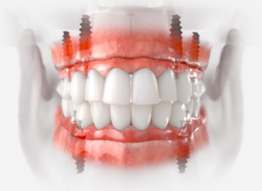 Model of All on 4 dental implants replacing a mouth of missing teeth