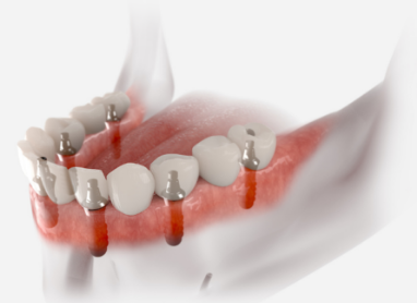 Model of dental implants replacing several teeth throughout the jaw