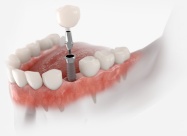 Model of a dental implant and crown replacing one missing tooth