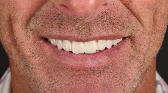 Close up of smile after treatment
