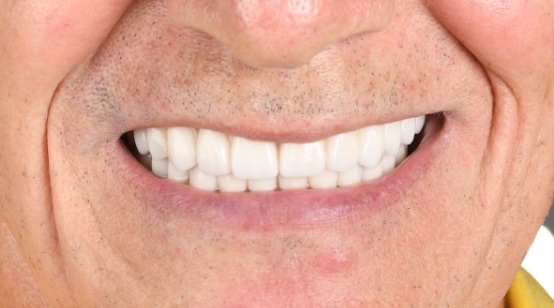 after treatment
