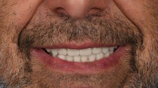 after treatment