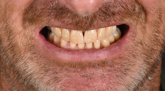 Close up of smile before treatment