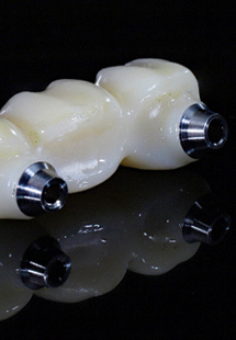 A dental implant bridge