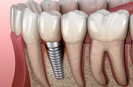 Illustration showing infected tissue around a dental implant
