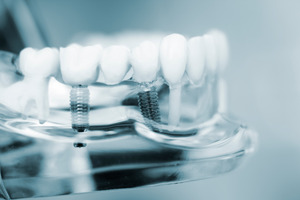 Close-up of dental implants in plastic model of mouth